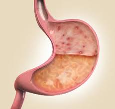 Gastritis: Causes, Classification, Diagnosis and Treatment