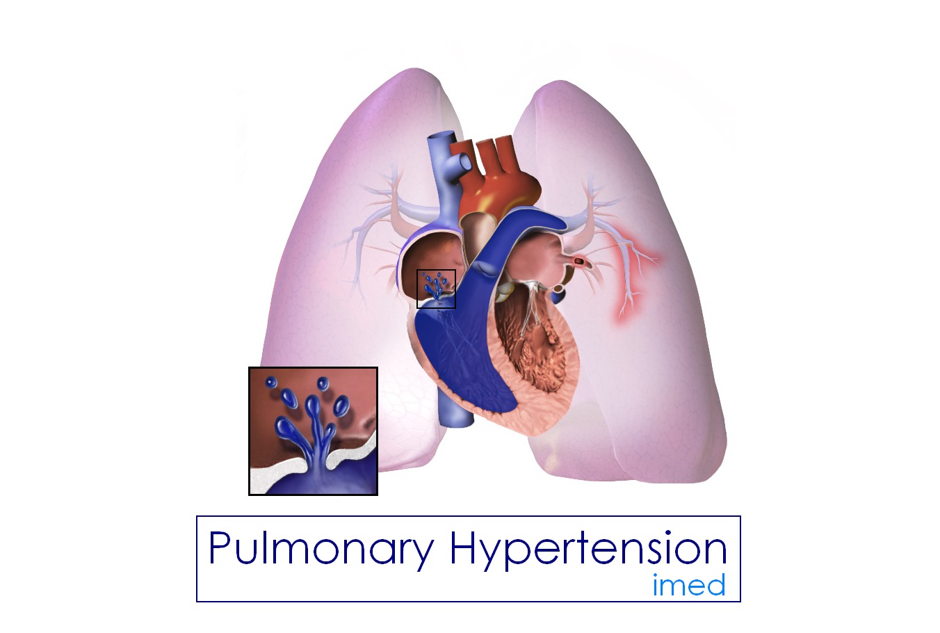 Pulmonary Hypertension: Causes, Symptoms and Treatment