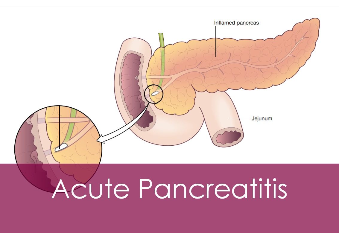 Acute Pancreatitis; Causes, Symptoms and Treatment