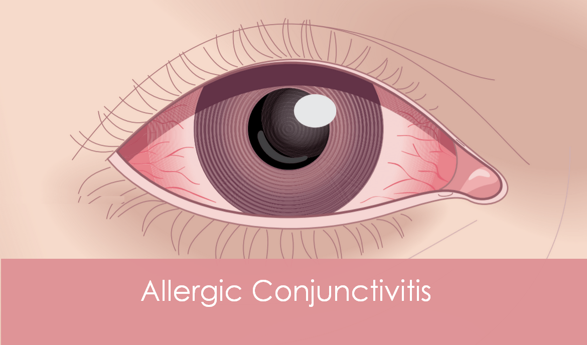 What is an allergic conjunctivitis?