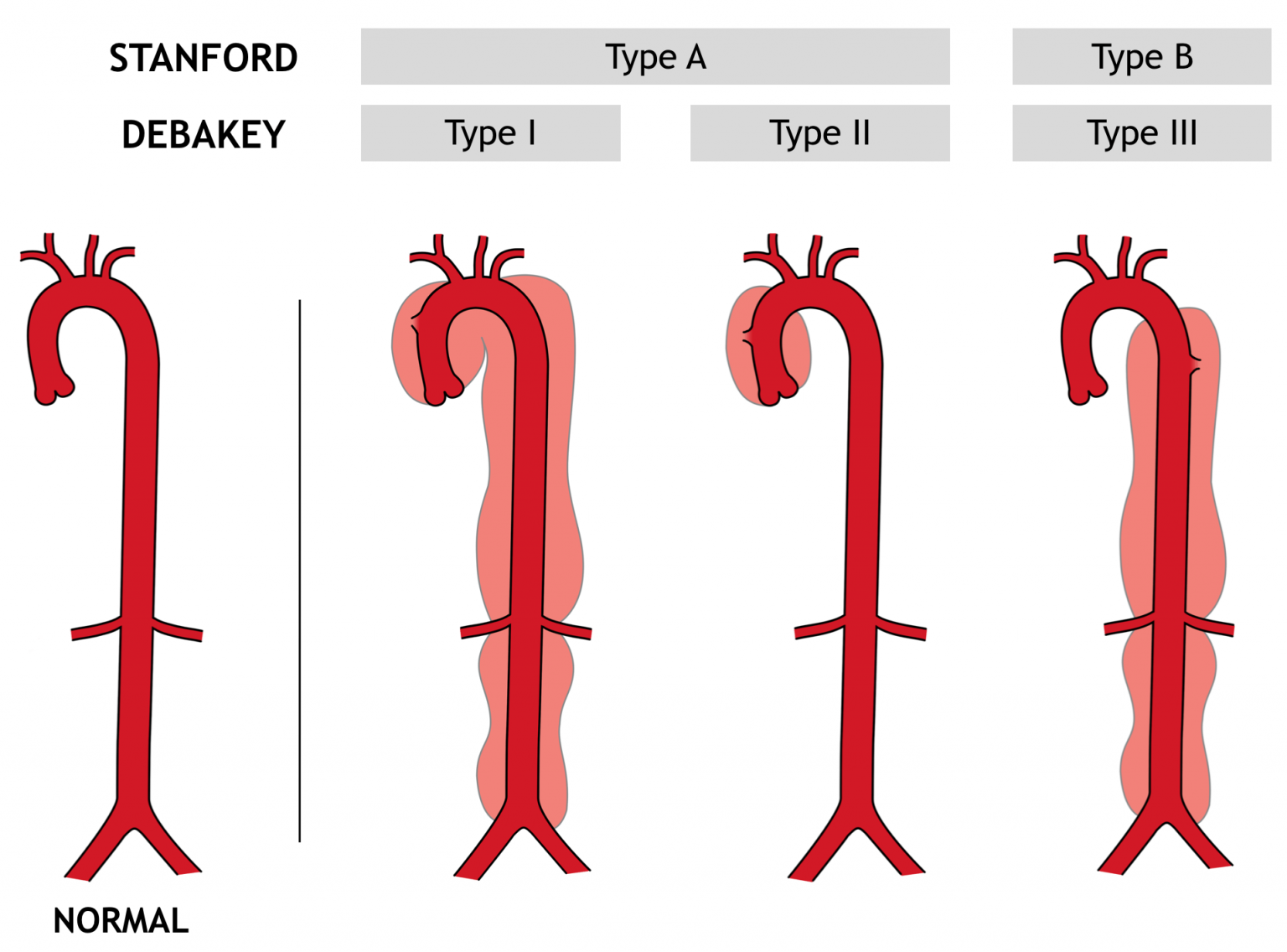 Aortic Dissection: Causes, Symptoms and Treatment