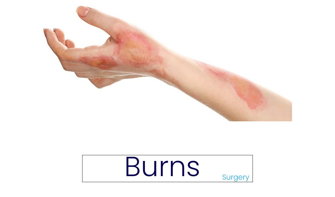 Burns : Types, Classification, Symptoms and Treatment