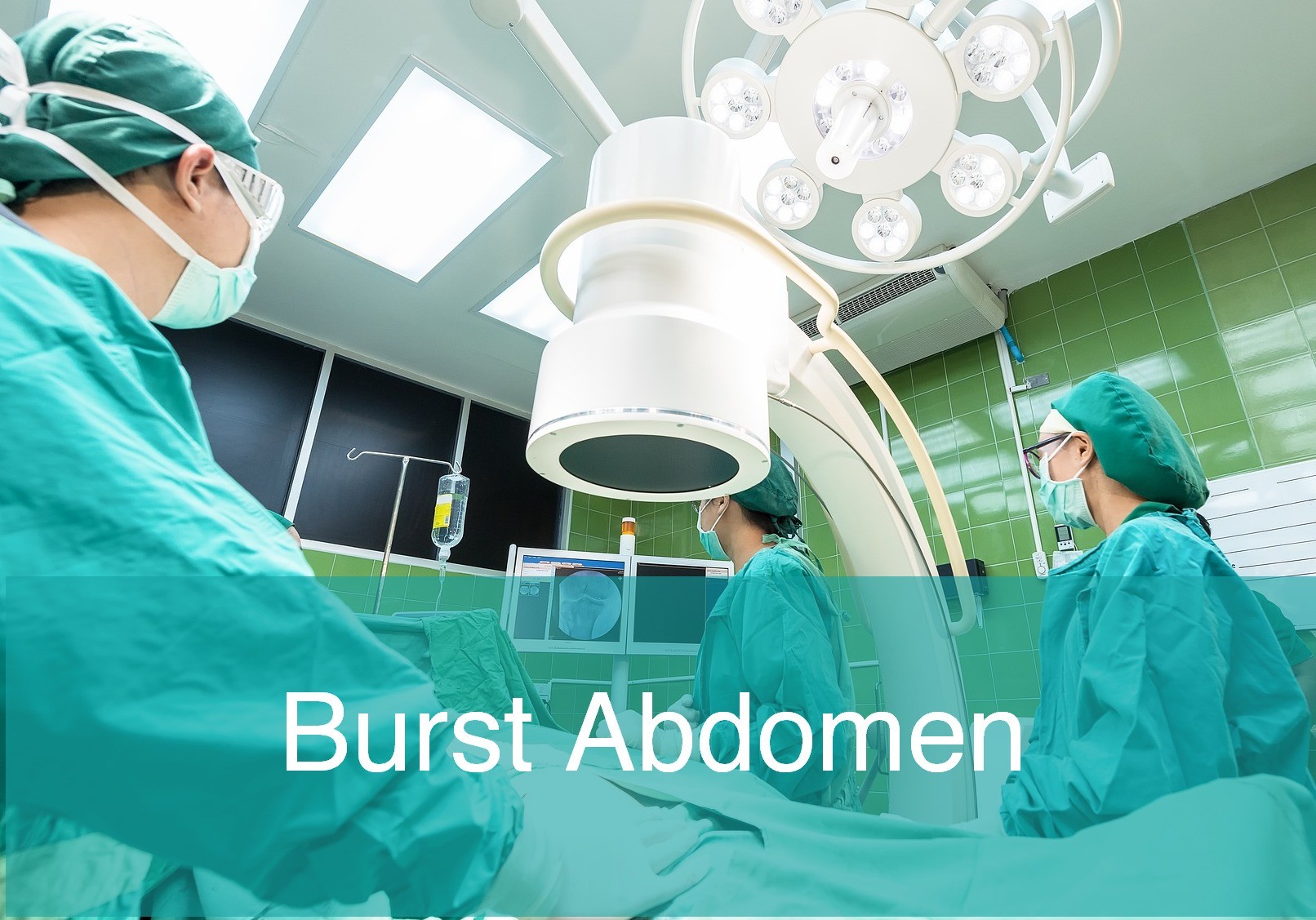 Burst Abdomen: Contributing factors and Treatment