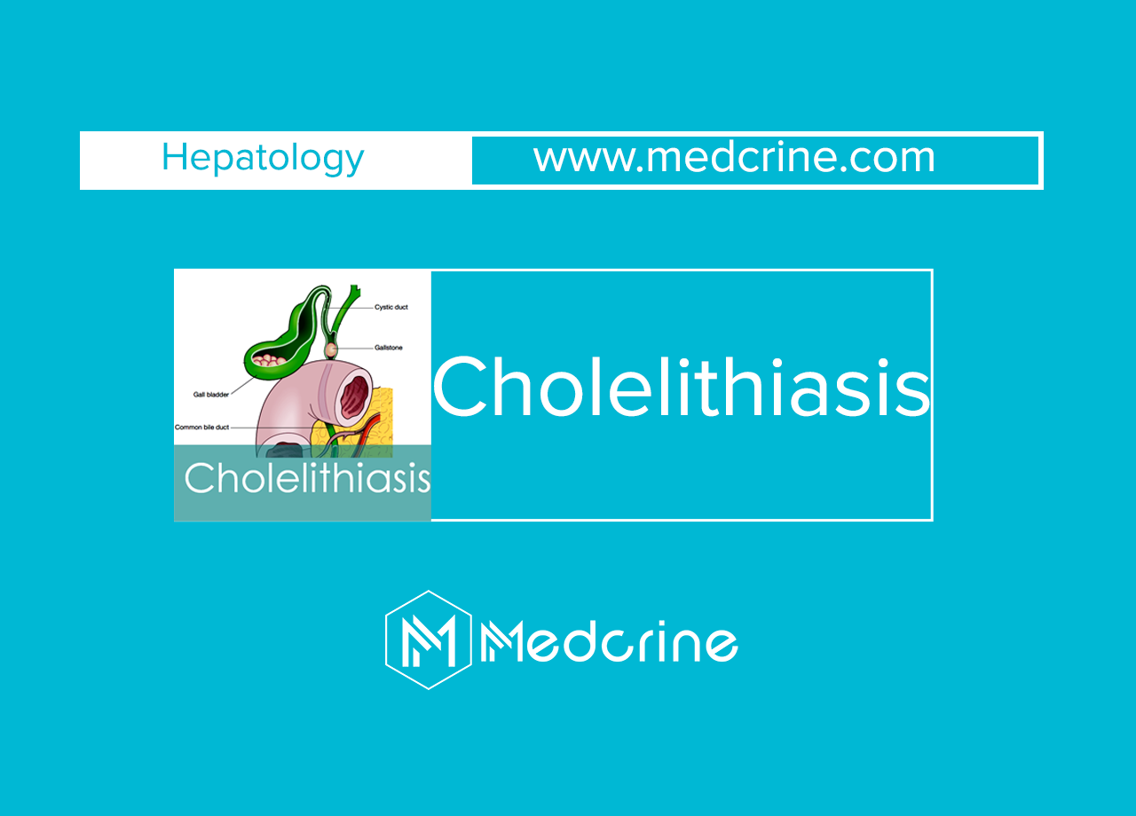 Cholelithiasis (Gall stones) : Causes, Pathophysiology, Symptoms and Treatment
