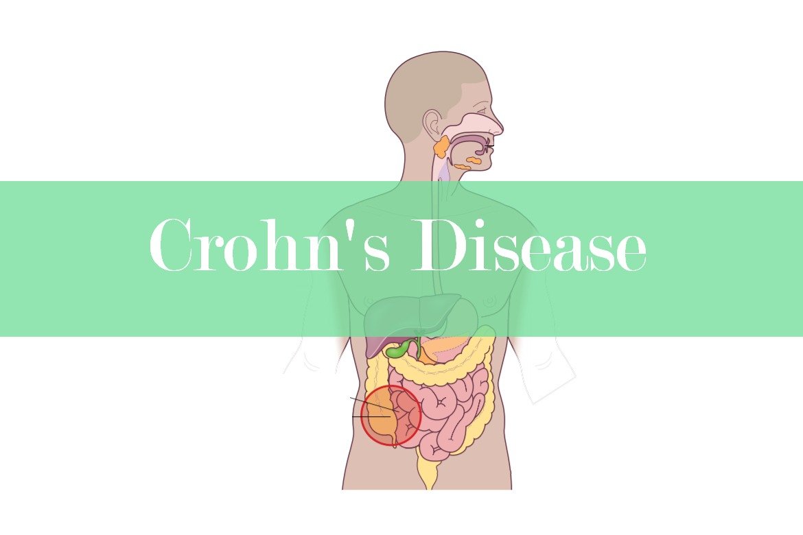 Crohn's Disease: Causes, Pathophysiology, Symptoms and Treatment