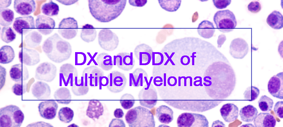 Diagnosis and differential diagnosis of multiple myelomas