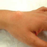 Ganglion Cyst: Causes, signs, Diagnosis and Treatment