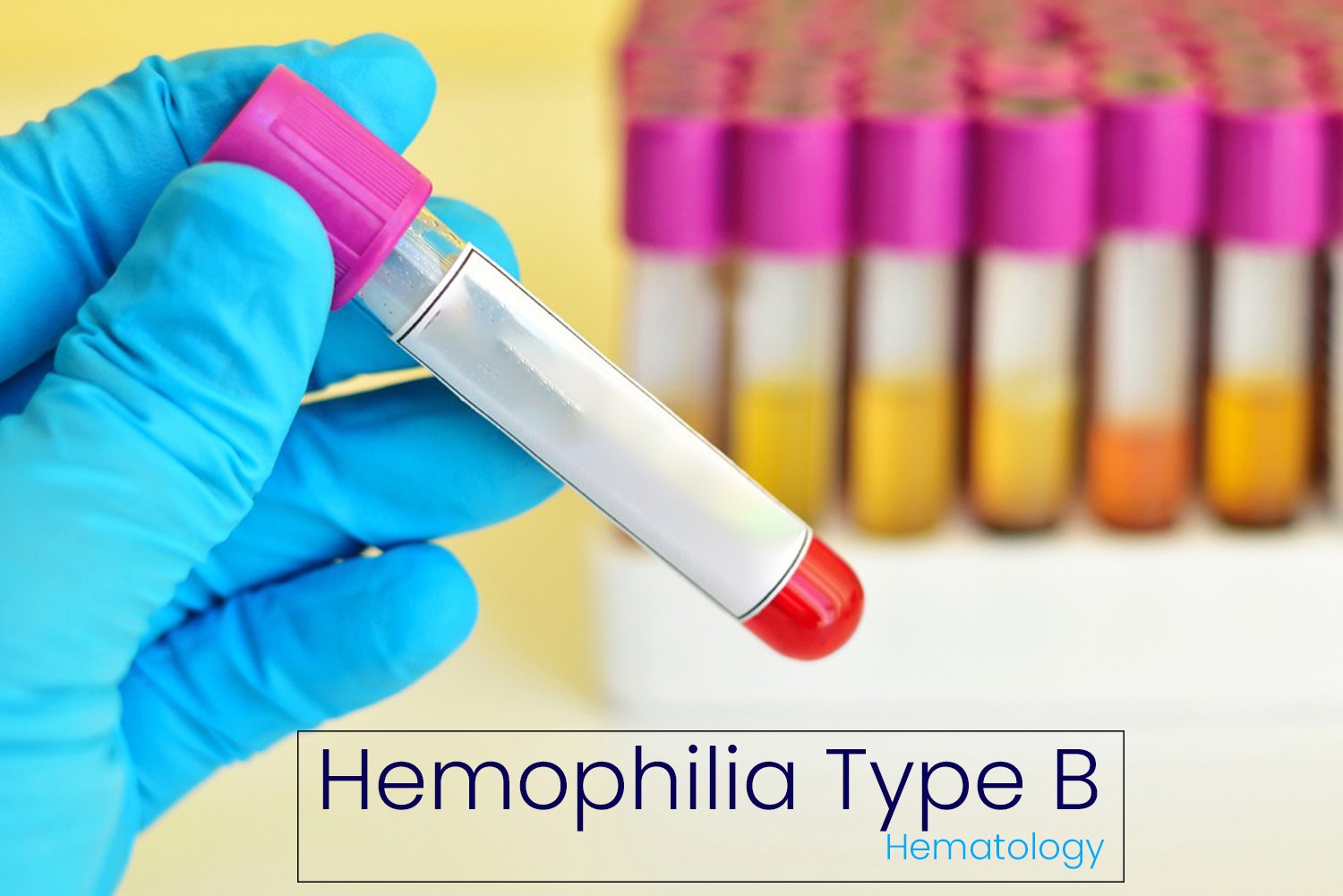Hemophilia B: Causes, Inheritance, Diagnosis and Treatment