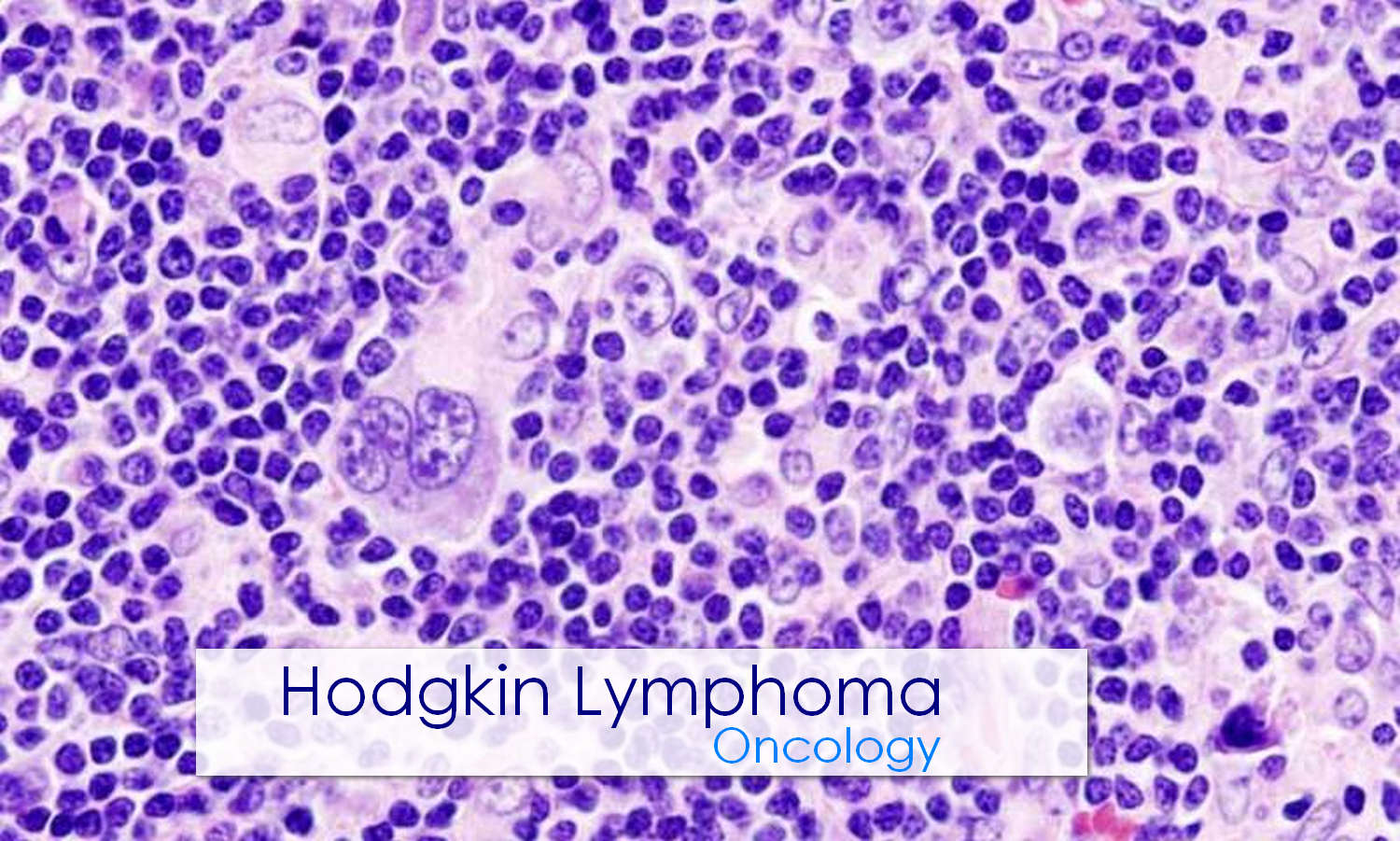 Hodgkin Disease (Lymphoma): Causes, Symptoms and Treatment