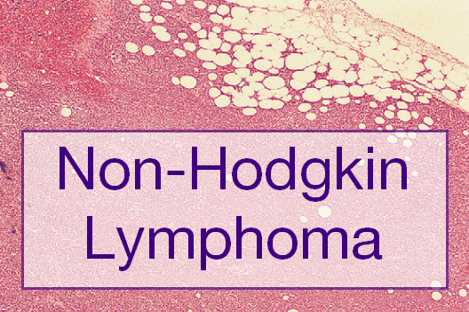 Non-Hodgkin Lymphoma: Symptoms, Diagnosis and Treatment