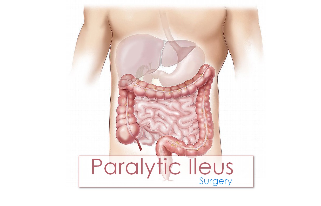 Ileus: Causes, Symptoms and Treatment