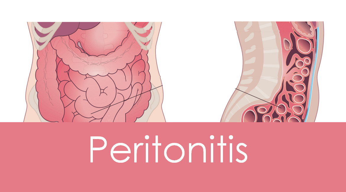 Peritonitis: Causes, Symptoms and Treatment
