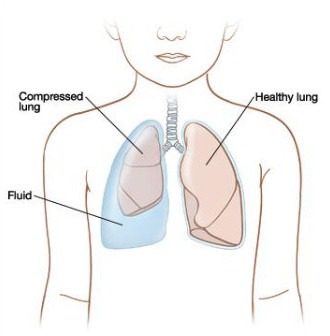 Pleural Effusion : Causes, Types, Symptoms and Treatment