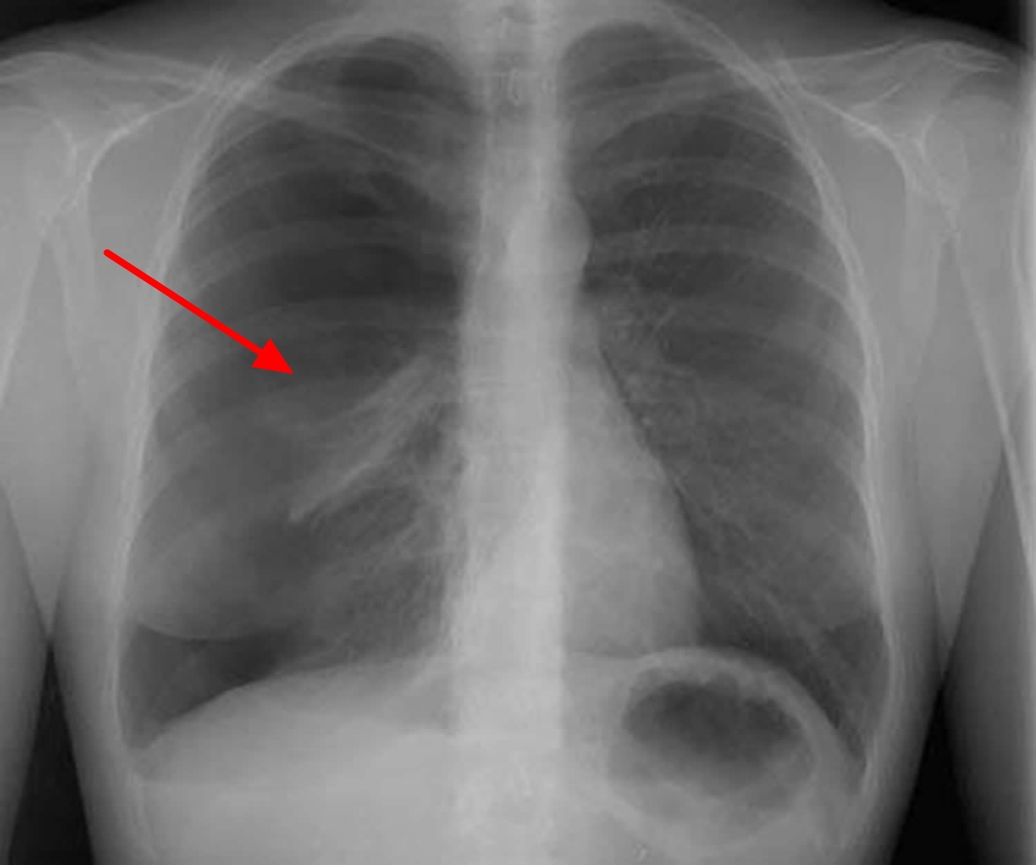 Pneumothorax : Causes, Symptoms and Treatment