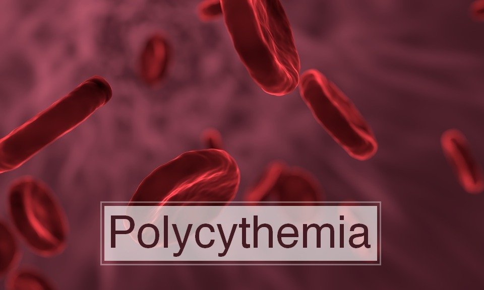 Polycythemia: Causes, symptoms, and management
