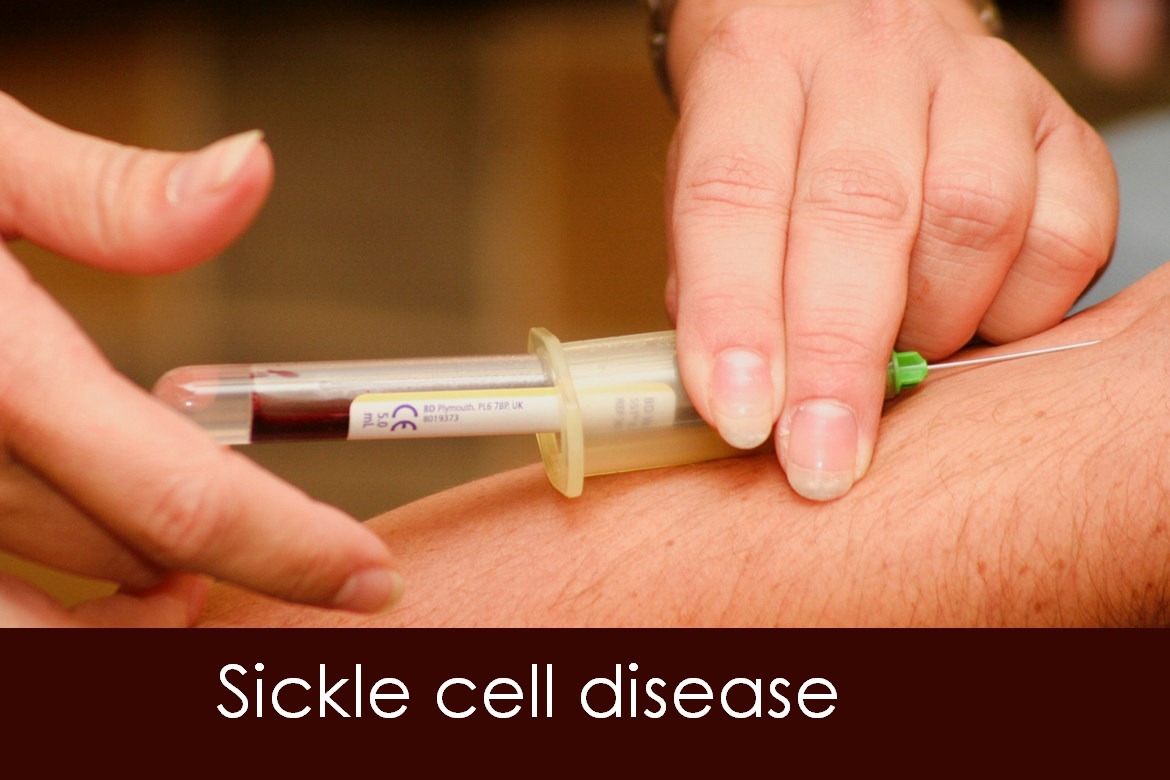 Sickle Cell Disease: Genetics, signs and symptoms, Treatment