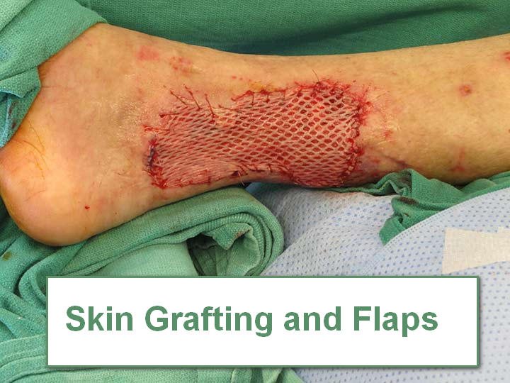 Skin Grafting and Flaps in Burn wounds