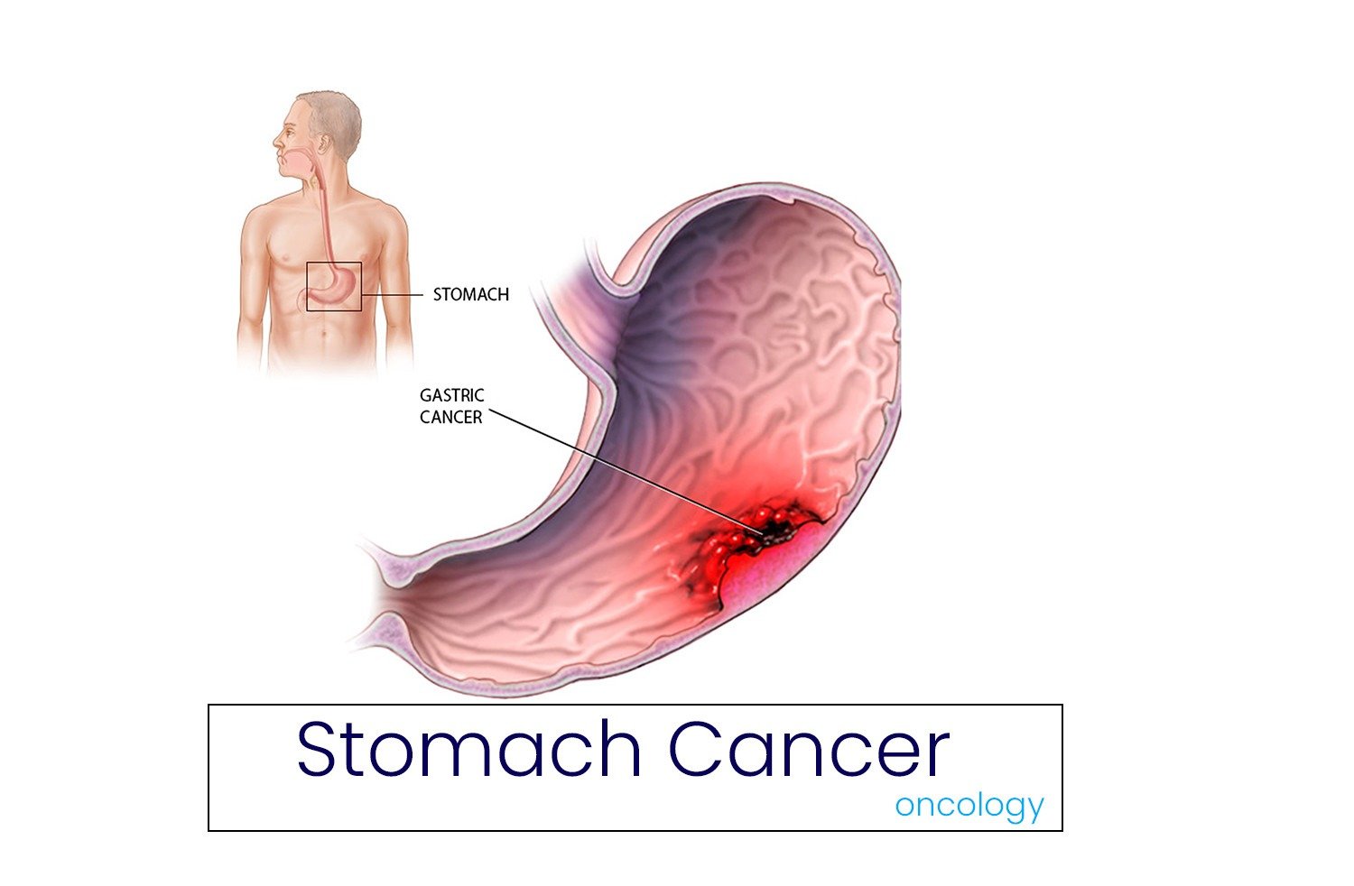 Stomach Cancer: Causes, Symptoms, Staging, Diagnosis and Treatment